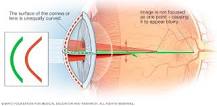 diferencia astigmatismo miopia